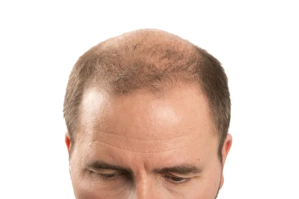 Calvitie Alopécie homme perte de cheveux soin des cheveux — Photo