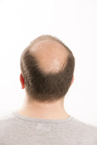 Baldness Alopecia man hair loss haircare — Stock Photo, Image