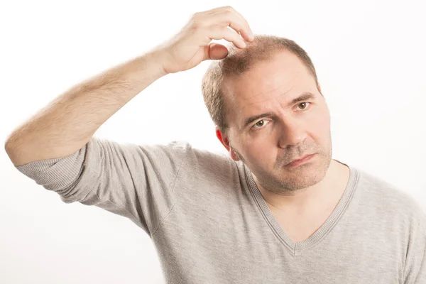 Calvície Alopecia homem queda de cabelo cuidado do cabelo — Fotografia de Stock