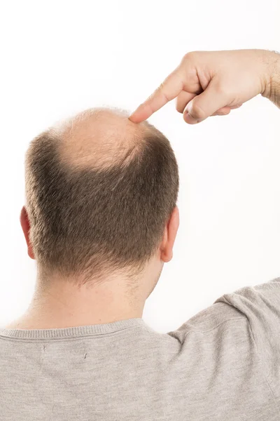 Φαλάκρα αλωπεκία άνθρωπος μαλλιά απώλεια περιποίησης μαλλιών — Φωτογραφία Αρχείου