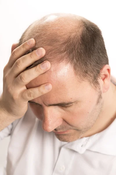 Calvizie Alopecia uomo perdita di capelli cura dei capelli — Foto Stock