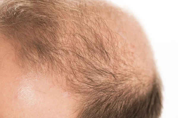 Botak Alopecia pria rambut kehilangan perawatan rambut — Stok Foto