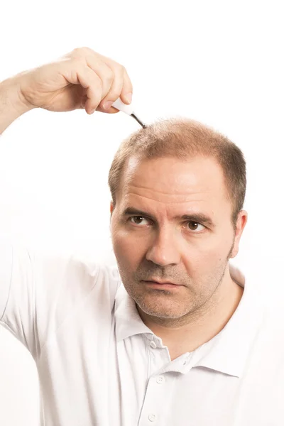 Haarausfall Haarausfall Haarpflege Mann — Stockfoto
