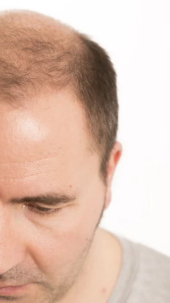 Calvície Alopecia homem queda de cabelo cuidado do cabelo — Fotografia de Stock