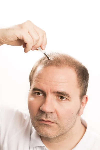 Calvície Alopecia homem queda de cabelo cuidado do cabelo — Fotografia de Stock