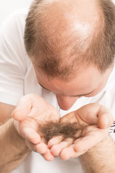 Muž alopecie plešatost, vypadávání vlasů — Stock fotografie