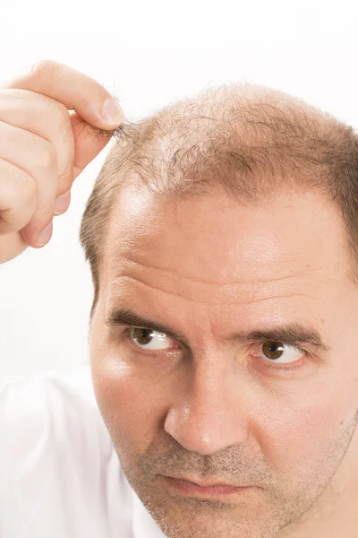 Baldness Alopecia man hair loss — Stock Photo, Image