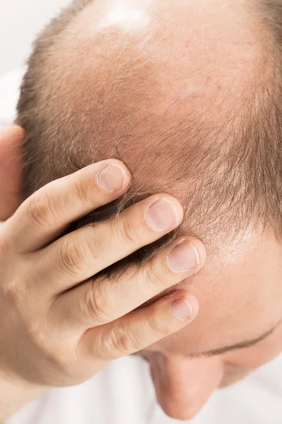 Calvície Alopecia homem perda de cabelo — Fotografia de Stock