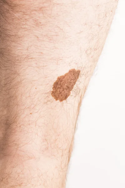 Znaménko krásy angioma melanomu — Stock fotografie