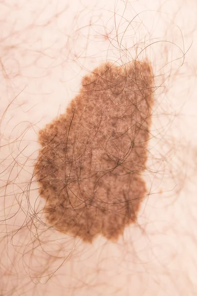 Marca de belleza de angioma de melanoma — Foto de Stock