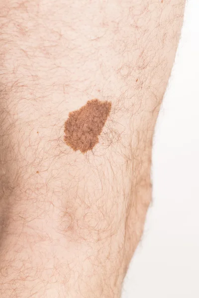 Melanoma angioma szépség mark — Stock Fotó