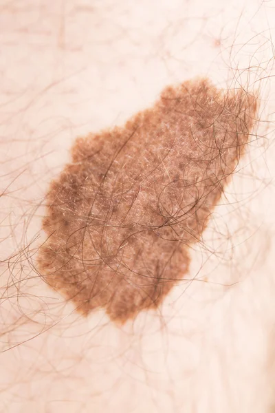 Marca de belleza de angioma de melanoma — Foto de Stock