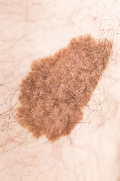 Znaménko krásy angioma melanomu — Stock fotografie