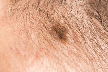 Melanom Anjiyom güzellik işareti