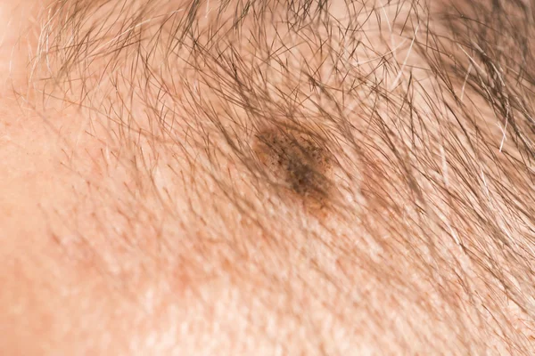 Marca de belleza de angioma de melanoma — Foto de Stock