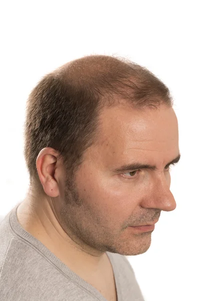 Baldness Alopecia man hair loss isolated — Stock Photo, Image