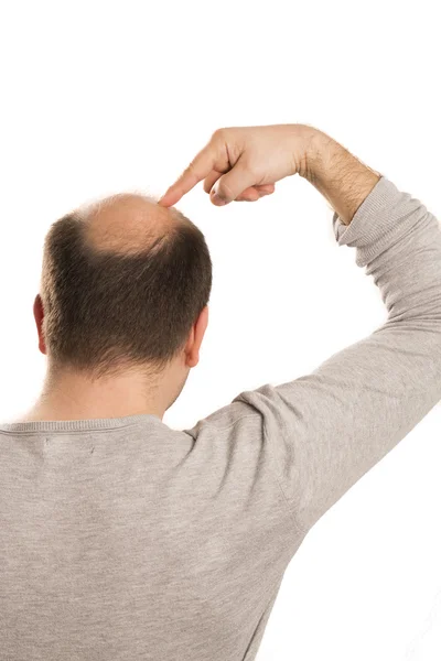 Baldness Alopecia man hair loss isolated — Stock Photo, Image