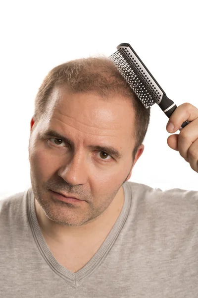 Calvície Alopecia homem perda de cabelo isolado — Fotografia de Stock