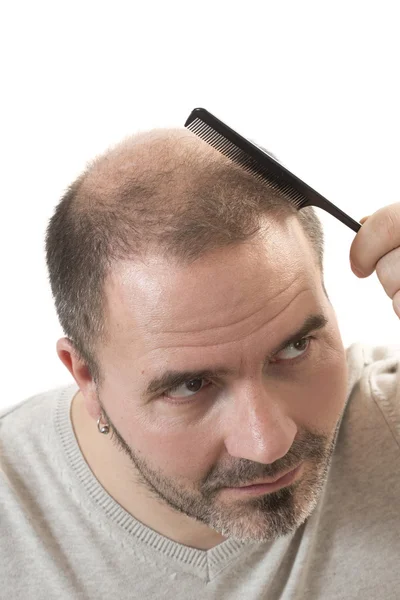 Homem alopecia calvície perda de cabelo isolado — Fotografia de Stock