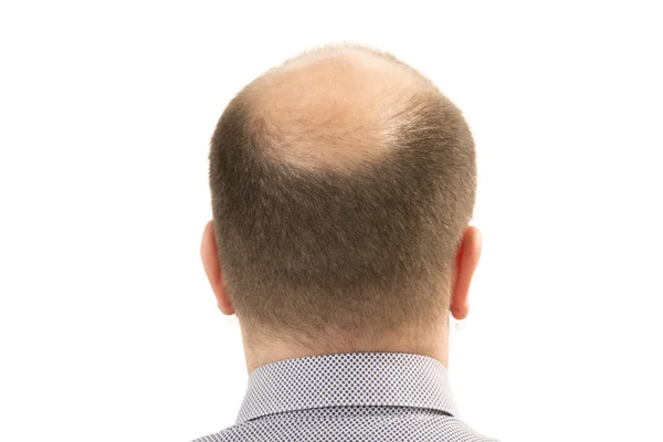 Man alopecia baldness hair loss isolated — Stock Photo, Image