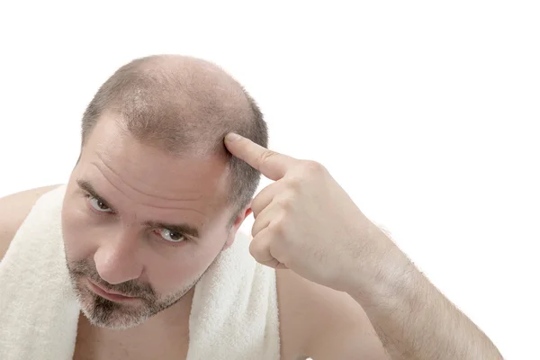 Alopecia hombre calvicie pérdida de cabello aislado — Foto de Stock