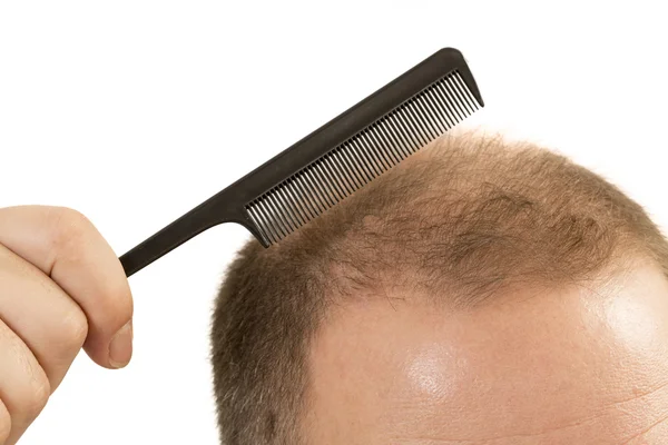 Man alopecia baldness hair loss isolated — Stock Photo, Image