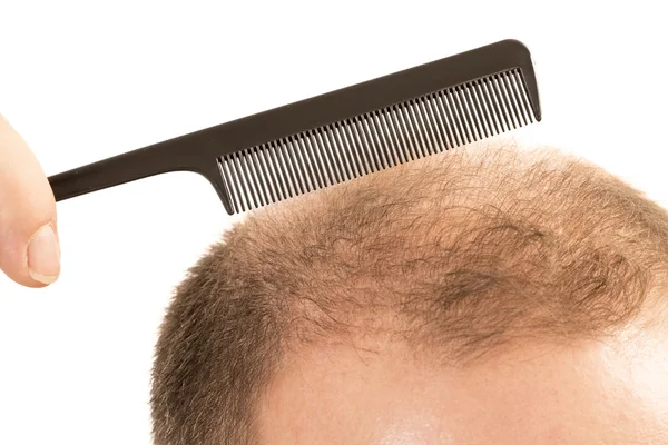Alopecia hombre calvicie pérdida de cabello aislado —  Fotos de Stock