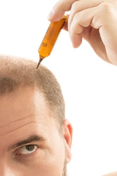 Мужчина облысение облысение выпадение волос изолированы — стоковое фото