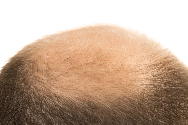 Homem alopecia calvície perda de cabelo isolado — Fotografia de Stock