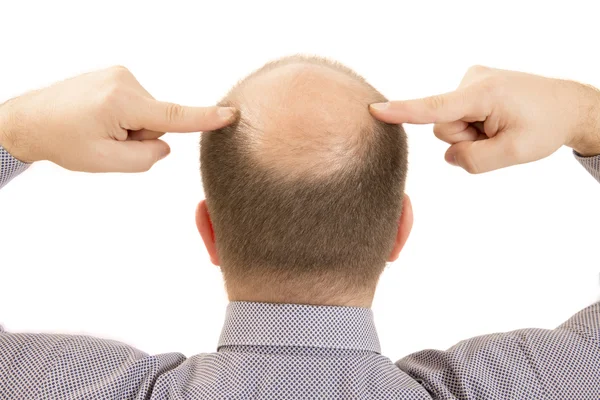 Man alopecia kaalheid haarverlies geïsoleerd — Stockfoto