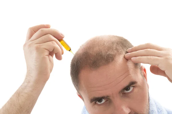 Mężczyzna łysienie łysienie Wypadanie włosów na białym tle — Zdjęcie stockowe