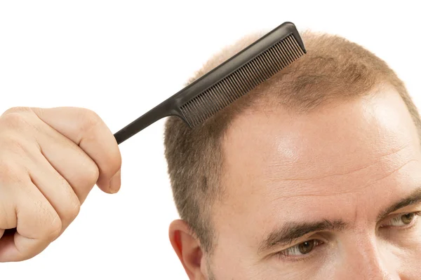 Homme alopécie calvitie perte de cheveux isolé — Photo