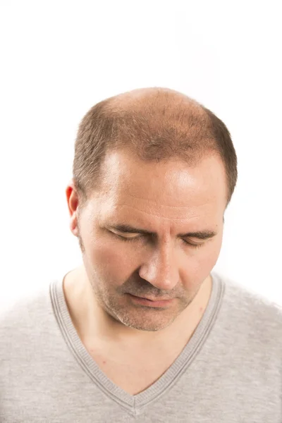 Hombre mayor y problema de pérdida de cabello —  Fotos de Stock