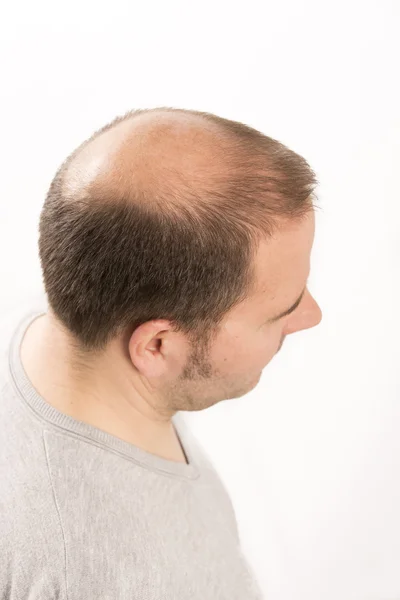 Hombre mayor y problema de pérdida de cabello — Foto de Stock