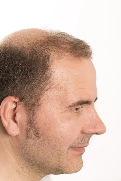 Hombre mayor y problema de pérdida de cabello —  Fotos de Stock