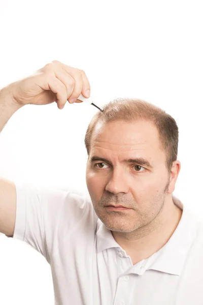 Homme âgé et problème de perte de cheveux — Photo