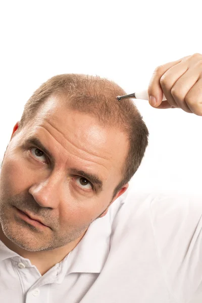 Senior man and hair loss issue — Stock Photo, Image