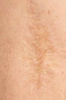 Kolundaki işlemi sonra yara izi