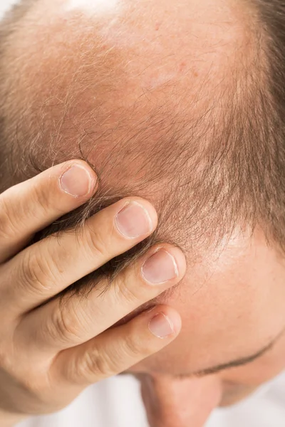 Homme âgé et problème de perte de cheveux — Photo