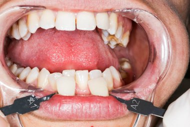 Diş kaplamasının kaplamasını kontrol etmek için dişçi muayenehanesinde bir gölge rehberi kullanıyor.