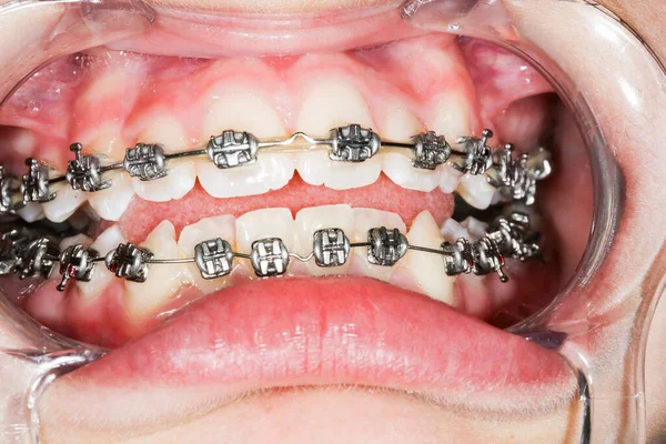 Close up Ceramic and Metal Braces on Teeth. Broad Smile with Self-ligating Brackets. Orthodontic Treatment. Woman face with mouth opener. At dental office