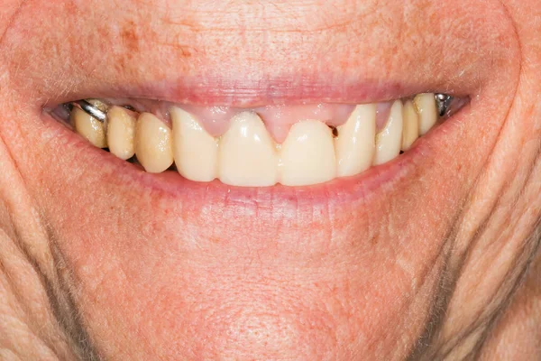 歯のインプラント 歯のインプラントの周りの骨の損失を引き起こす病気 ねじの露出と歯肉炎の後退を見ることができます — ストック写真