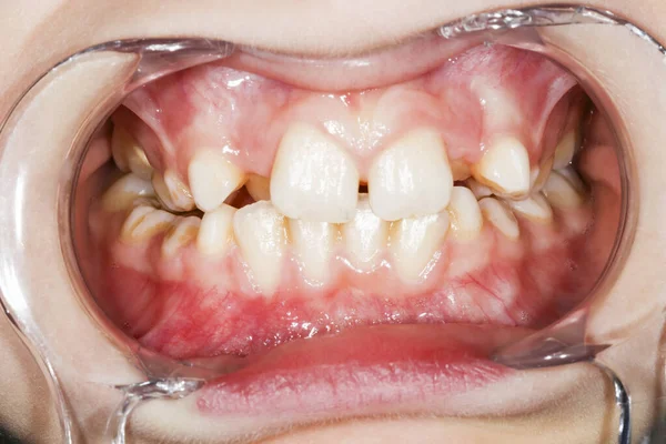 Intra-oral picture of teeth and gum in the smile mouth oral care. Bacteria, dental plaque is the cause of gingivitis and tooth decayed. Mouth opener used by dentistry