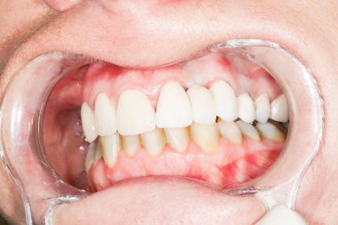 Kadın dişleri beyazlamadan önce ve sonra. Kusurlu diş yapısı. Yukarı, aşağı, dişçinin yanına, ağız açıcı ile. Fransa