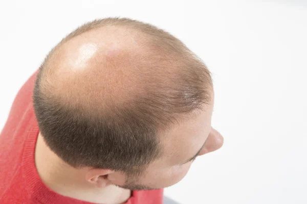 Calvicie prematura, hombre, 40 años, fondo blanco — Foto de Stock