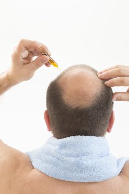 Erken kellik, erkek, 40 yaşlarında, beyaz arka plan