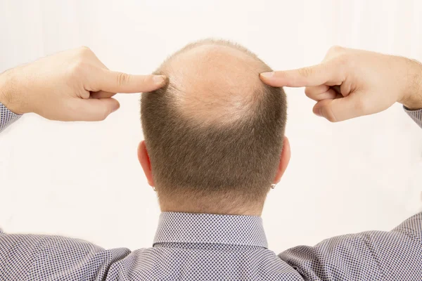 Premature baldness, man, 40s, white background — Stock Photo, Image