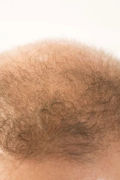 För tidigt håravfall, man, 40-talet, vit bakgrund — Stockfoto