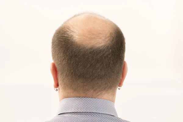 Premature baldness, man, 40s, white background — Stock Photo, Image