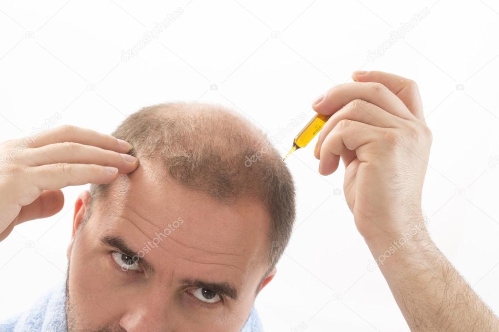 Premature baldness, man, 40s, white background